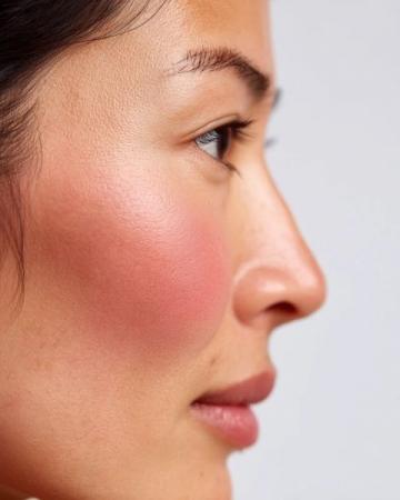 如何告別紅腫痘痘？這些護(hù)膚技巧助你遠(yuǎn)離煩人痘疹